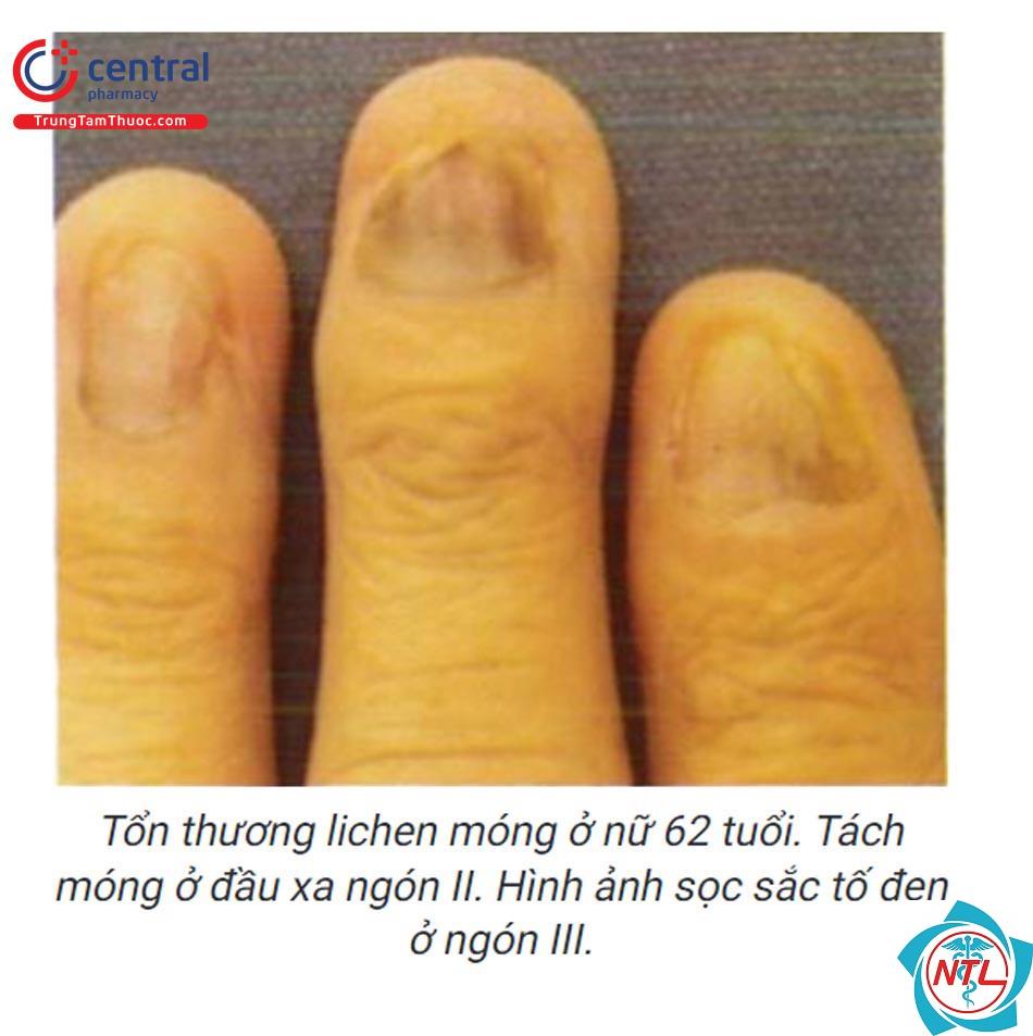 lichen phẳng ở móng - Image 3