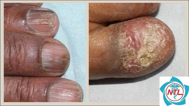 lichen phẳng ở móng