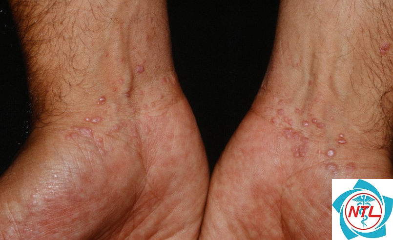lichen phẳng ở người lớn