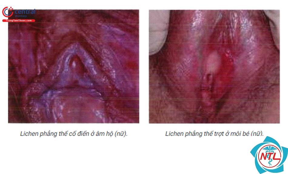 lichen phẳng vùng sinh dục - Image 2