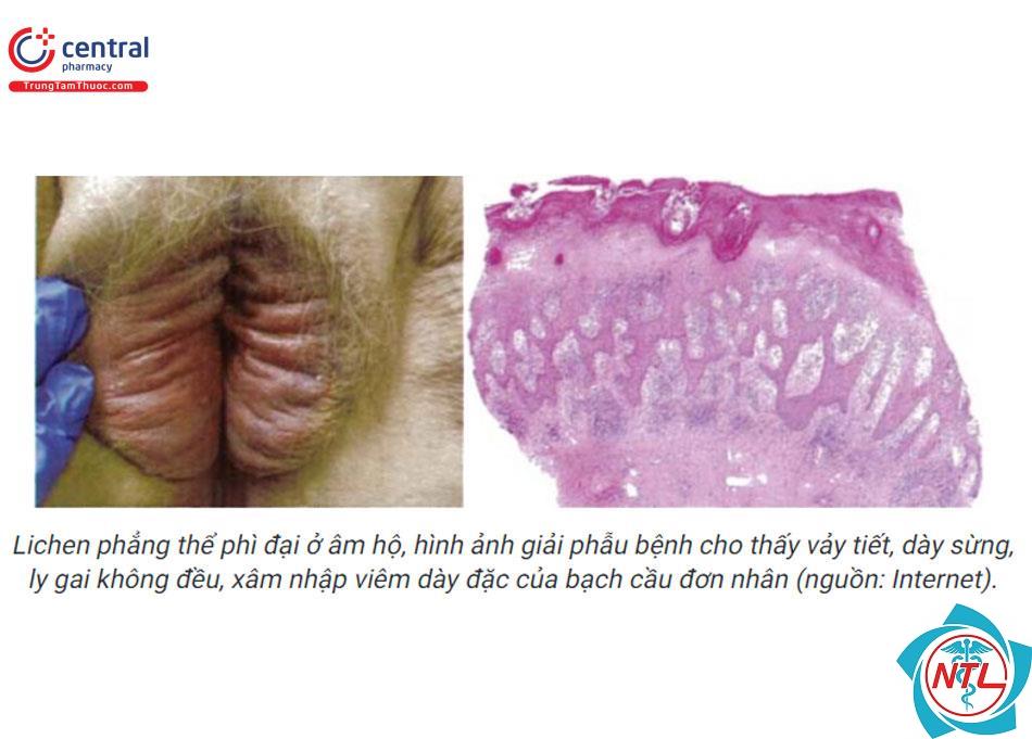 lichen phẳng vùng sinh dục - Image 3