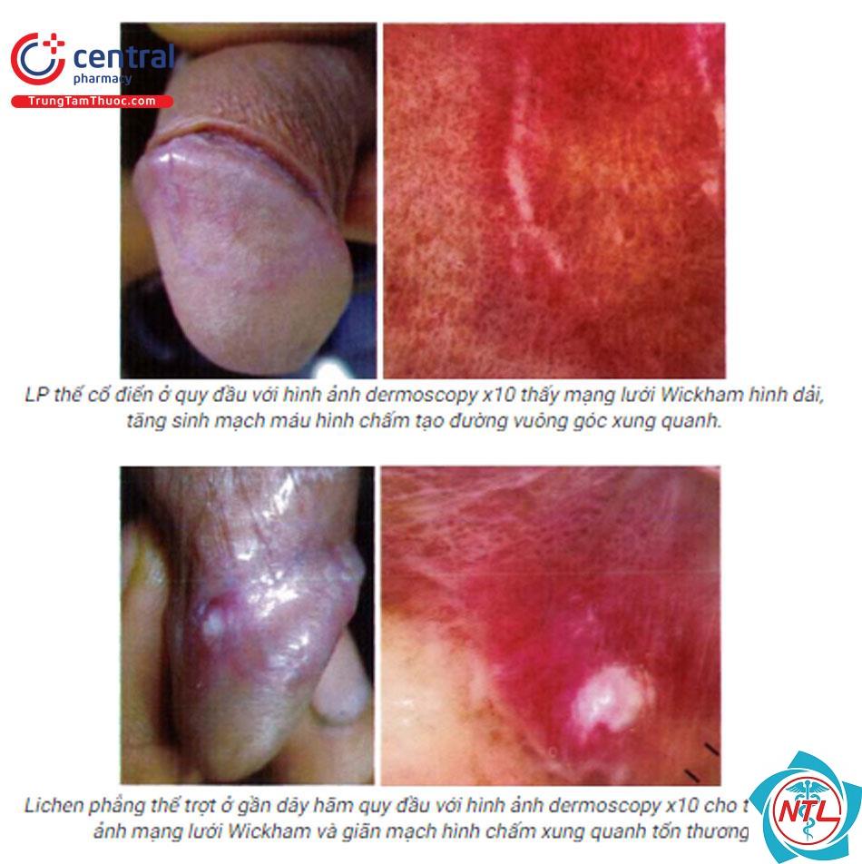 lichen phẳng vùng sinh dục - Image 4