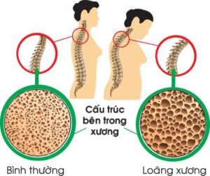 loãng xương