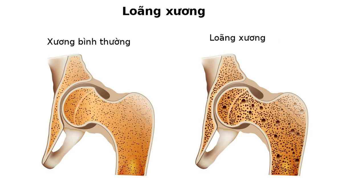 loãng xương - Image 5