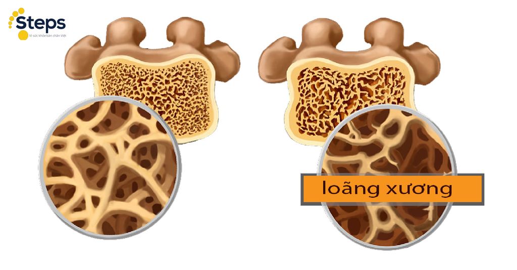 loãng xương là gì - Image 2