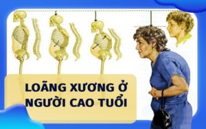 loãng xương ở người cao tuổi