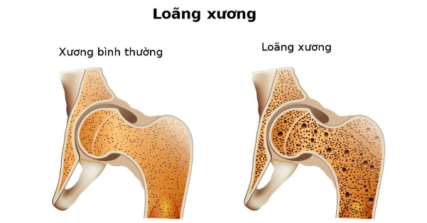 loãng xương ở người cao tuổi - Image 5