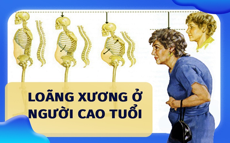loãng xương ở người cao tuổi - Image 1