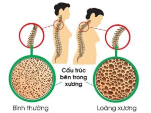 loãng xương ở phụ nữ sau mãn kinh