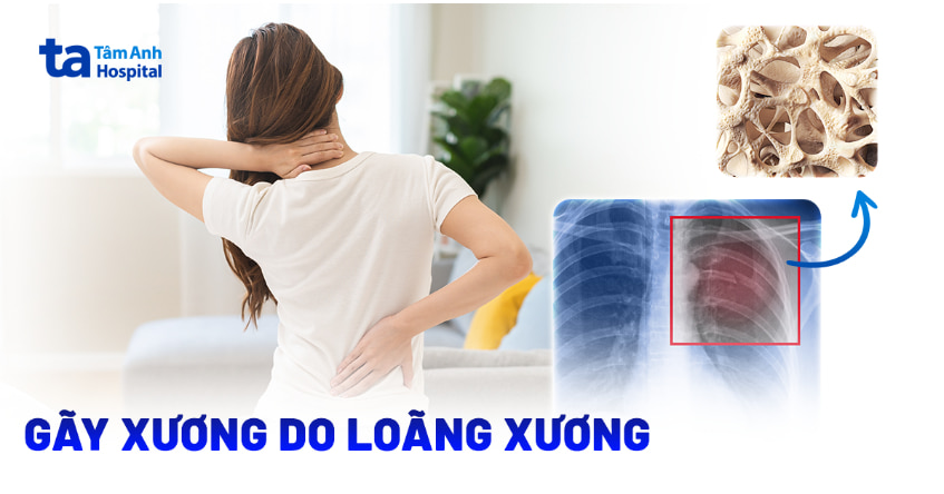 loãng xương sau gãy xương - Image 5