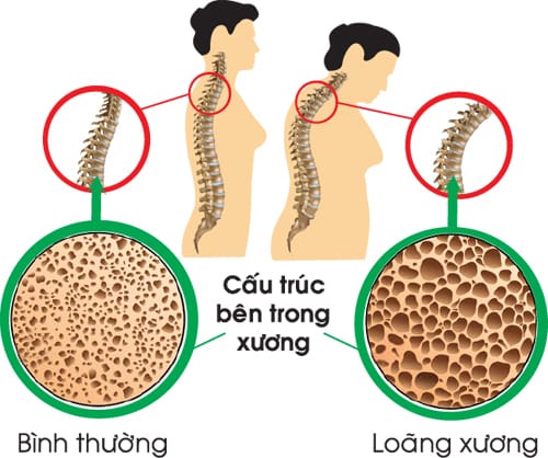 loãng xương