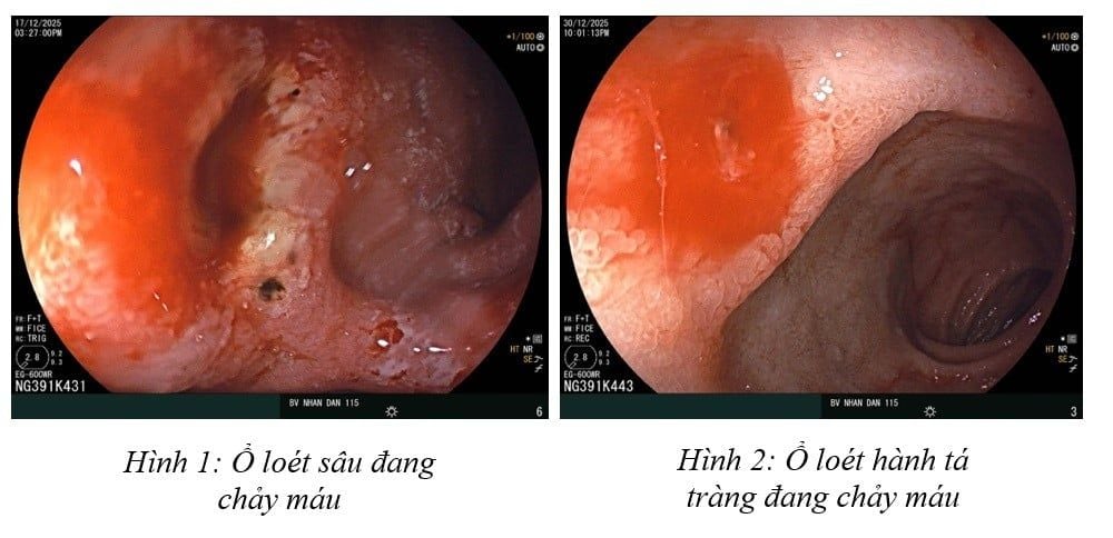 loét dạ dày kèm xuất huyết - Image 5