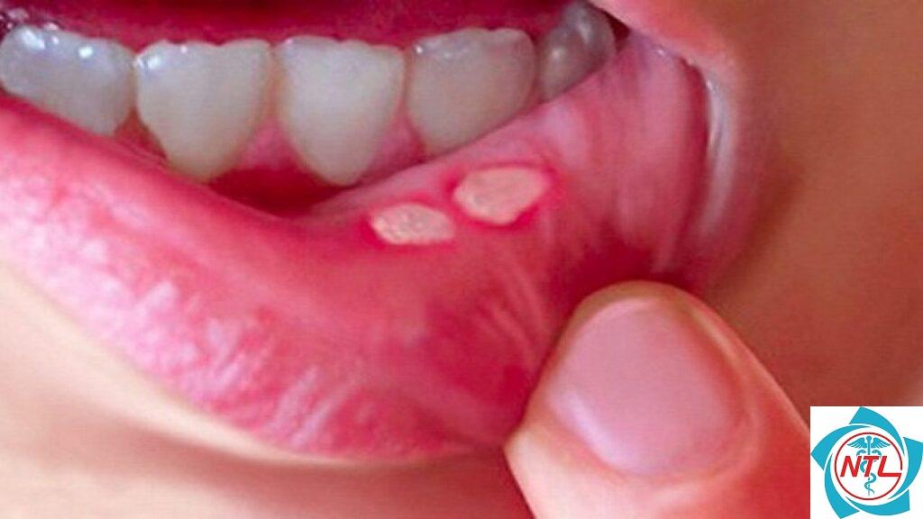 loét miệng tái phát do bệnh da