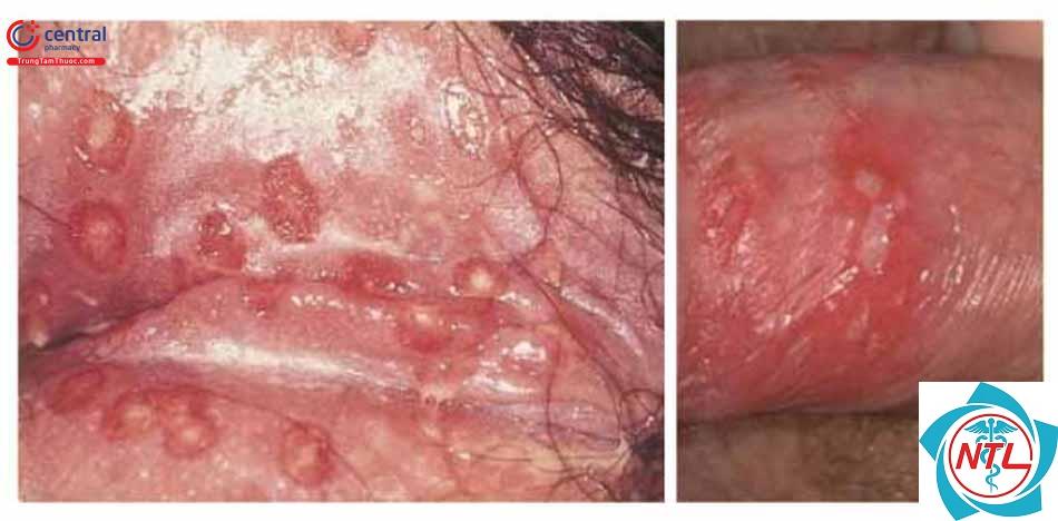 loét sinh dục do bệnh tự miễn - Image 2