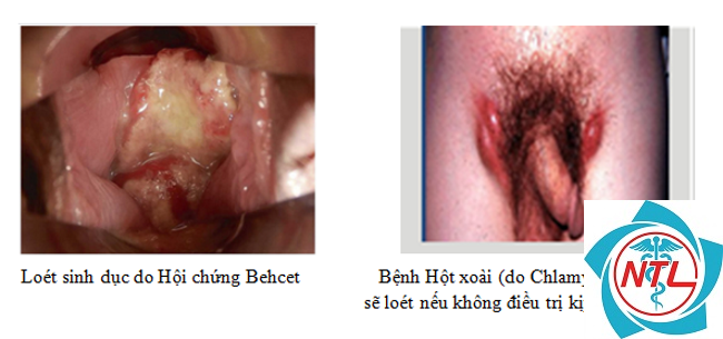 loét sinh dục do bệnh tự miễn - Image 3
