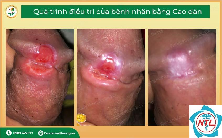 loét sinh dục do bệnh tự miễn - Image 5