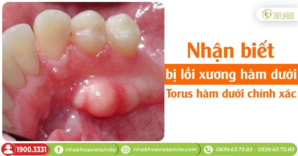 lồi xương hàm dưới - Image 2