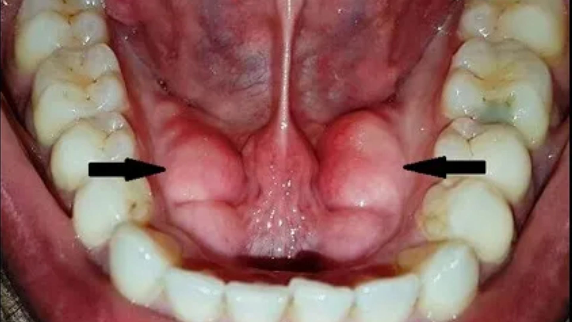 lồi xương hàm dưới - Image 3