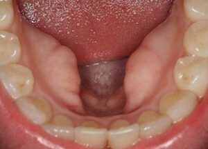 lồi xương hàm dưới