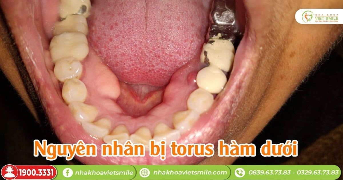 lồi xương hàm dưới - Image 5