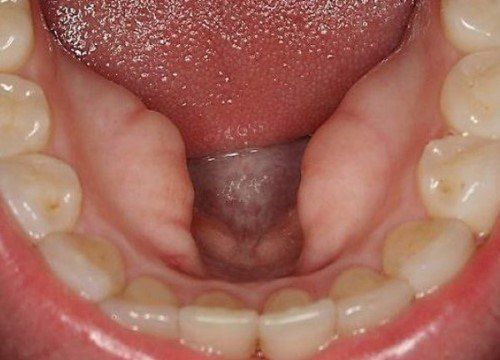 lồi xương hàm dưới