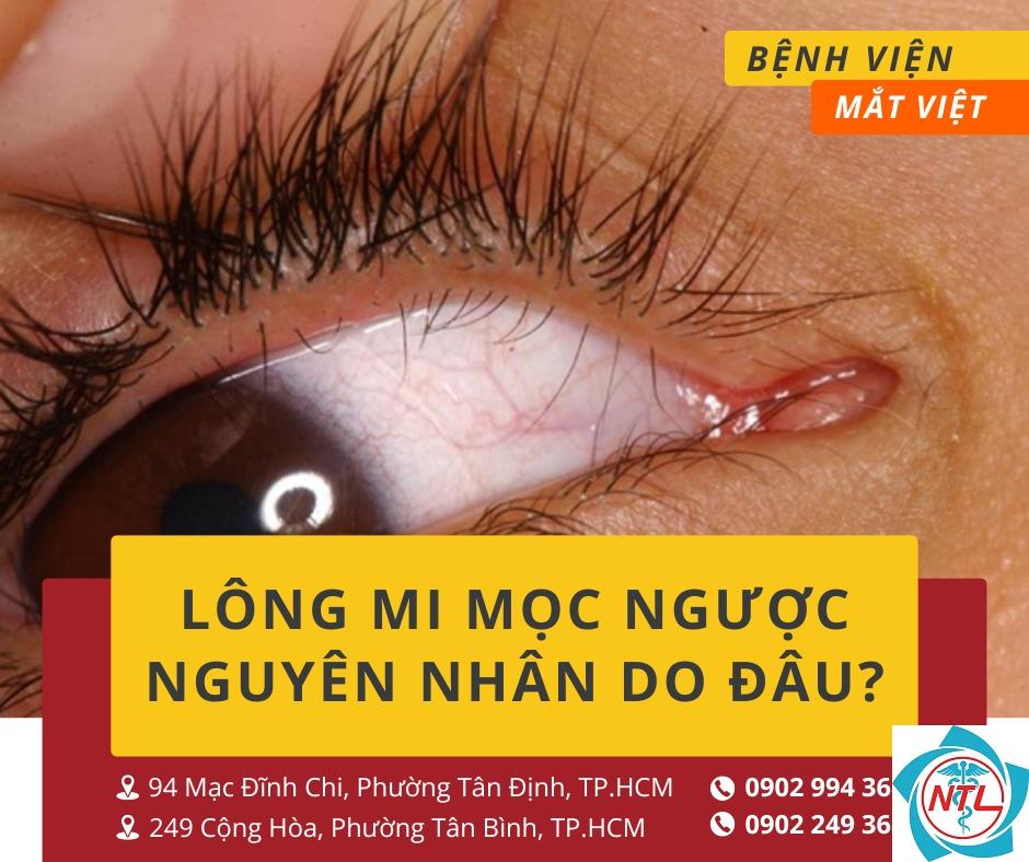lông mi mọc ngược - Image 4