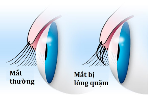 lông mi quặm - Image 2