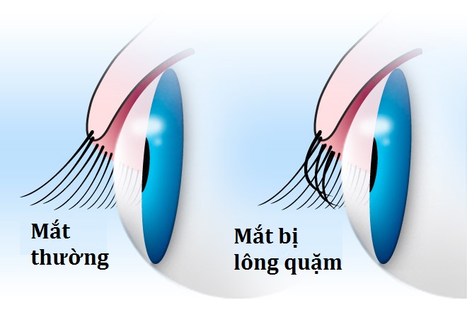 lông quặm - Image 2