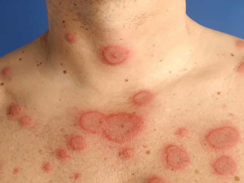 lupus ban đỏ da - Image 2