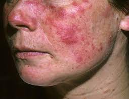 lupus ban đỏ da - Image 3