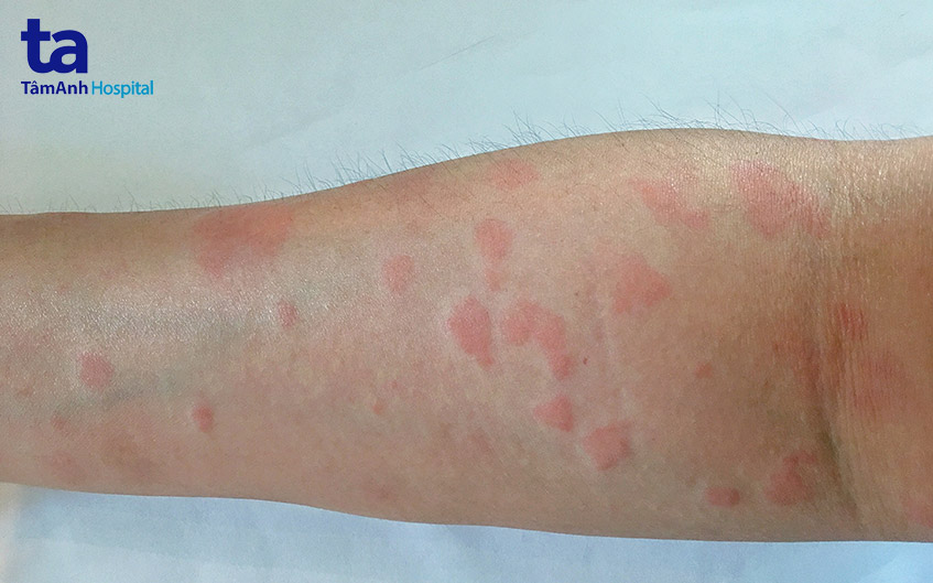 lupus ban đỏ da
