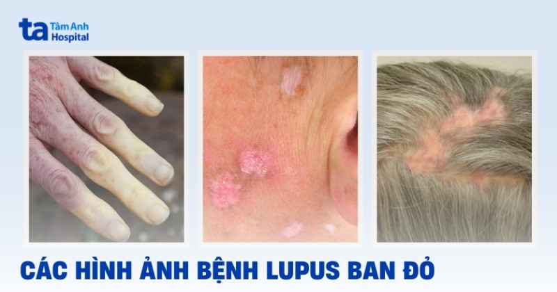 lupus ban đỏ ở da - Image 2