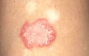 lupus ban đỏ ở da - Image 3