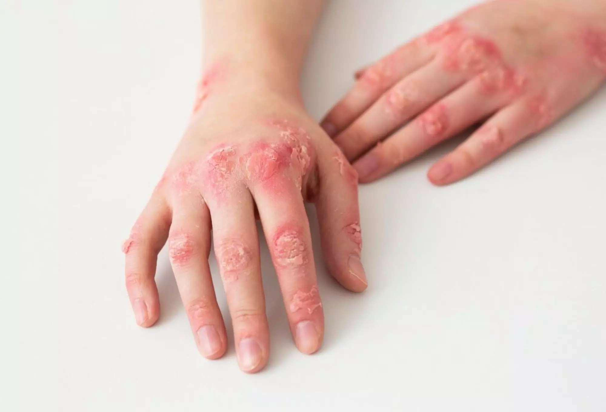 lupus ban đỏ ở da - Image 4