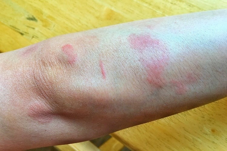 lupus ban đỏ ở da - Image 5