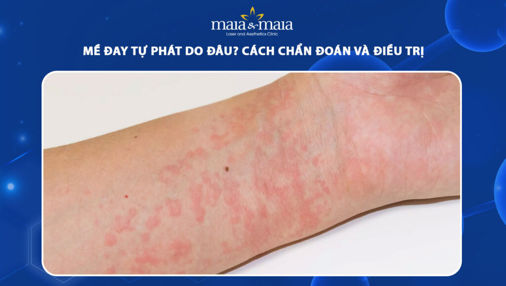 mày đay tự phát - Image 4
