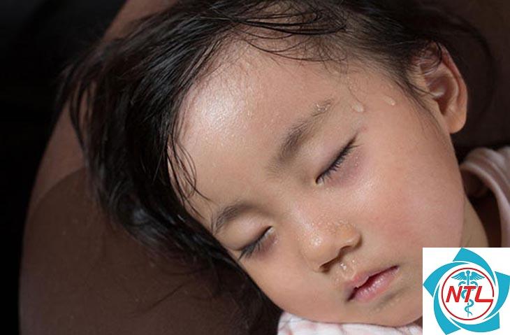 mồ hôi trộm trên da - Image 5