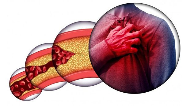 mỡ máu cao ở người cao tuổi