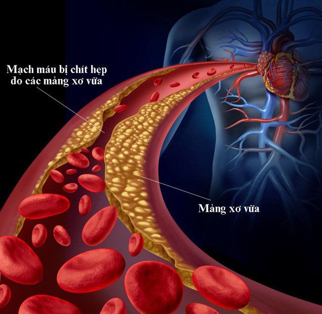 mỡ máu cao ở người tiểu đường - Image 3
