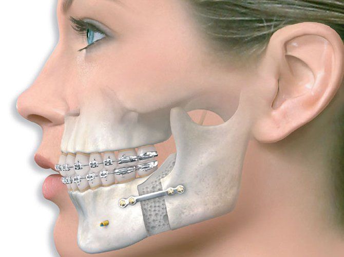 mổ tháo nẹp vít xương hàm dưới