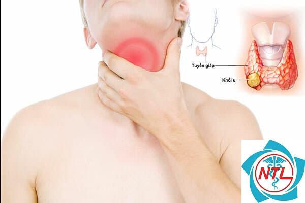 mổ u tuyến giáp nằm viện bao lâu - Image 2