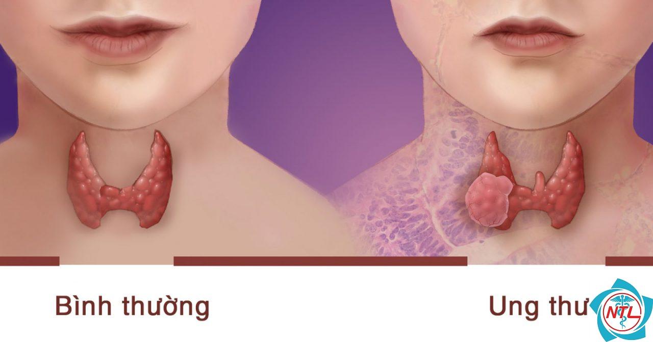 mổ u tuyến giáp nằm viện bao lâu - Image 3
