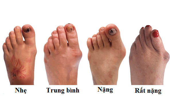 móng chân biến dạng - Image 5