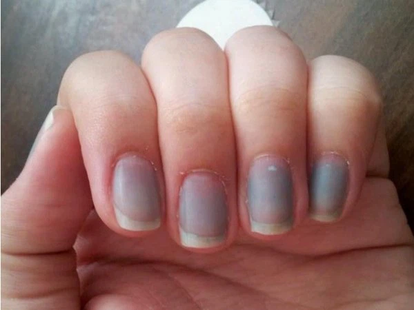 móng tay bị đổi màu - Image 2