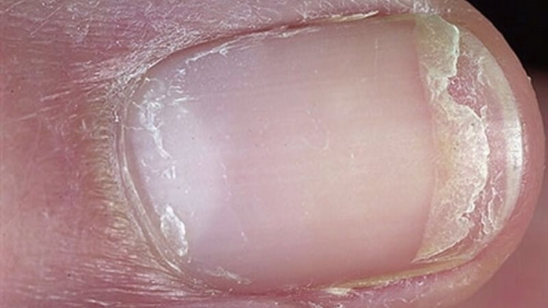 móng tay dễ gãy - Image 4