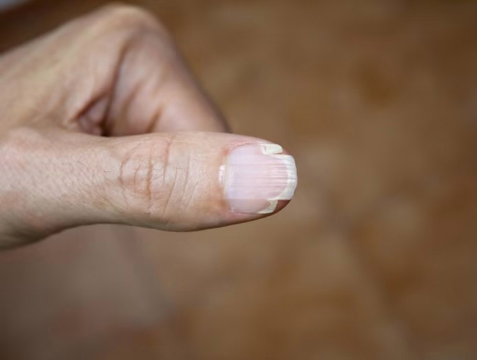 móng tay dễ gãy
