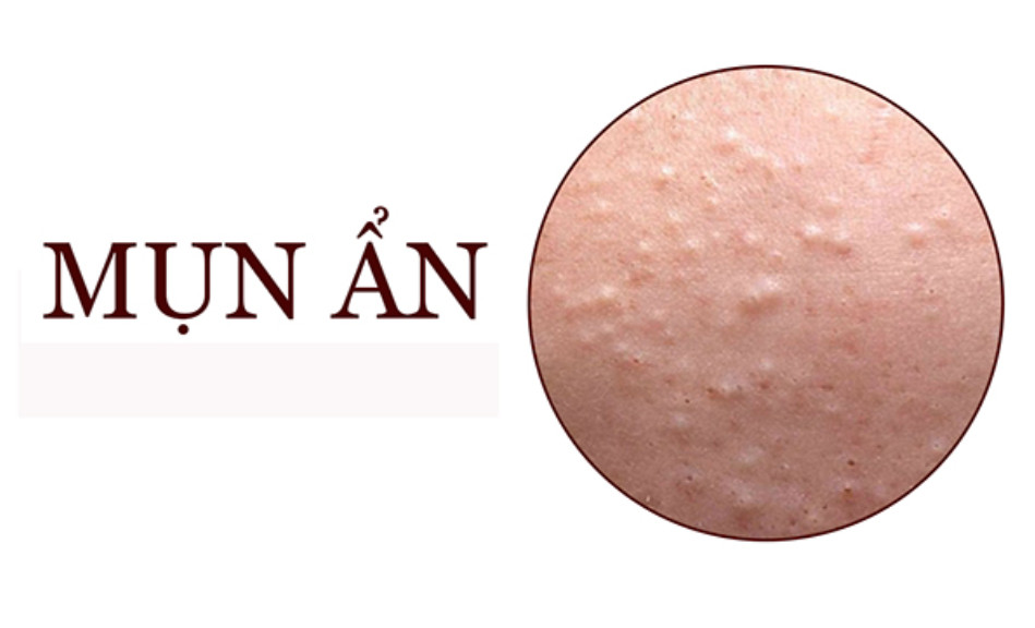mụn ẩn - Image 4
