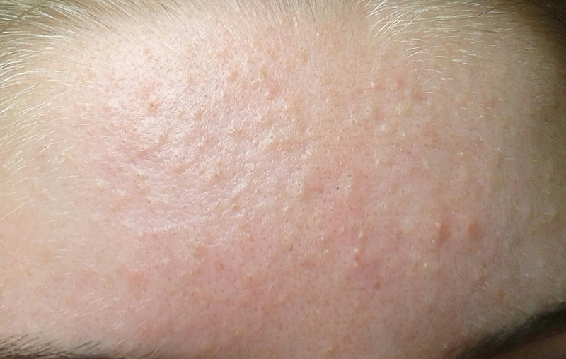 mụn ẩn - Image 1