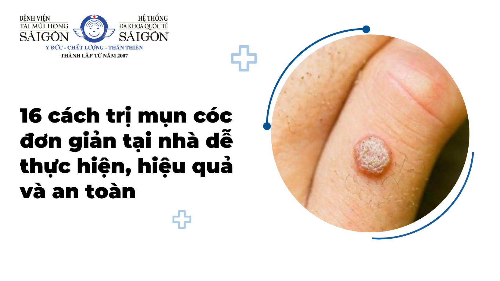 mụn cóc - Image 3