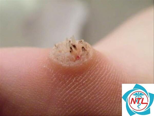 mụn cóc do HPV - Image 2